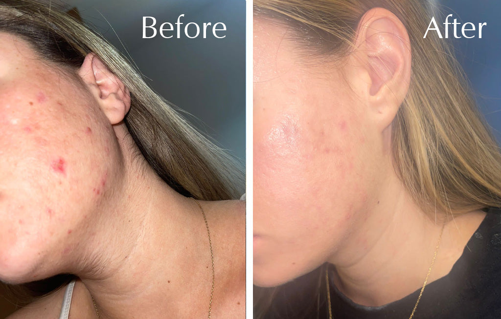 Skin Renewal Facial Peel