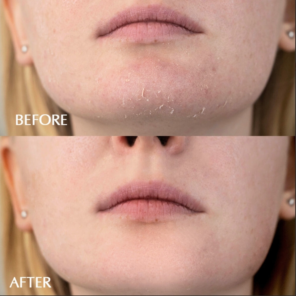 Skin Renewal Facial Peel