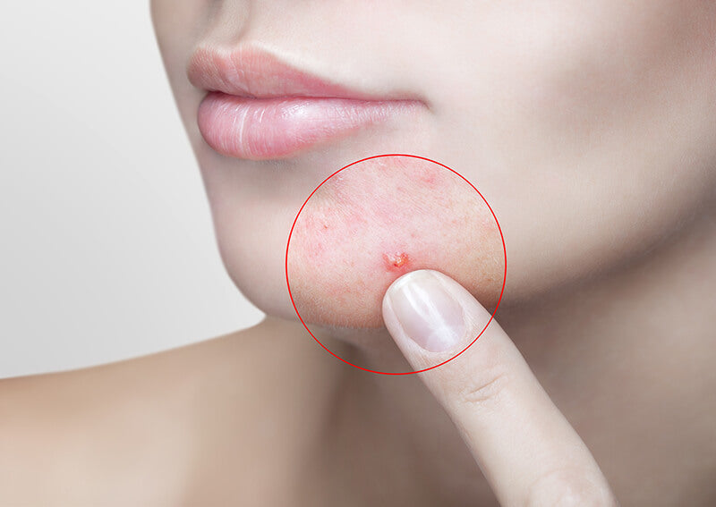 EXPERT TIPS: DEALING WITH ADULT ACNE
