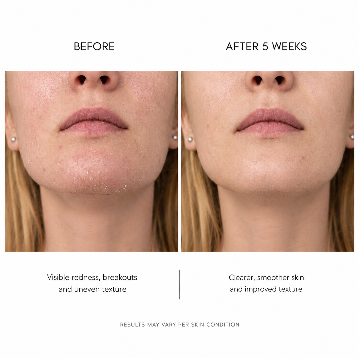 Skin Renewal Facial Peel